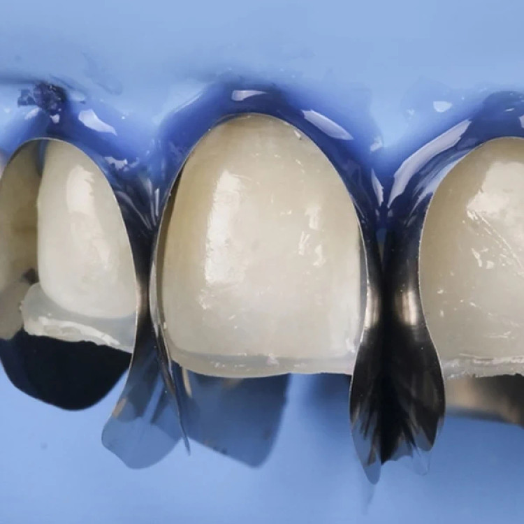 ماتریکس سکشنال قدامی 12 عددی DDS Dent